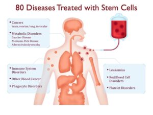 Stem cell therapy explained