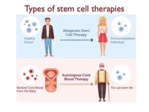 Stem cell therapy explained